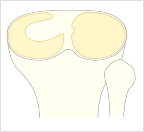 discoid meniscus